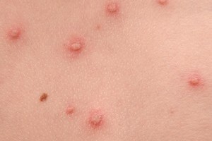 A bárányhimlő (varicella, hólyagos himlő) tünetei és kezelése A bárányhimlő (varicella, hólyagos himlő) tünetei és kezelése