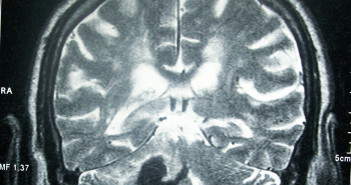 Hogyan csökkentsük a stroke bekövetkezésének esélyeit Stroke